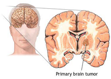 Brain Tumor