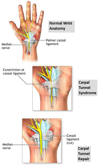 Carpal Tunnel Syndrome