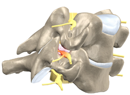 Cervical Radiculopathy