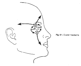 Cluster Headaches