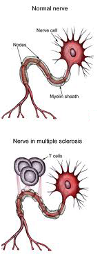 Multiple Sclerosis