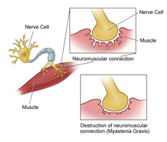 Myasthenia gravis