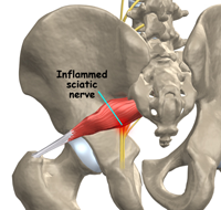 Sciatica