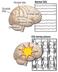 Seizures